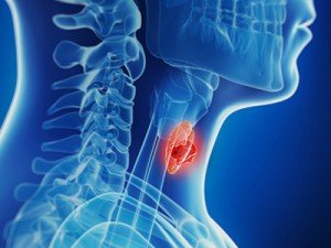 cancer-tireoide